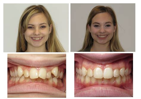 Can Invisalign Actually Fix An Overbite Impact Orthodontics