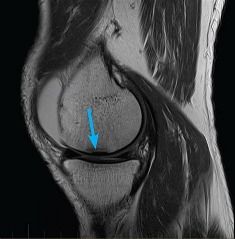Mr Imaging Of Meniscal Tears With Discoid Lateral Meniscus European My Xxx Hot Girl