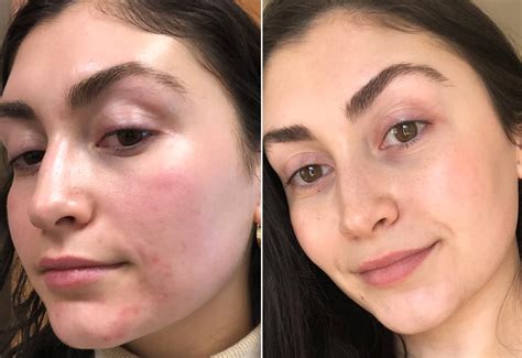 What To Know About Laser Treatments For Red Acne Marks Popsugar Beauty Uk
