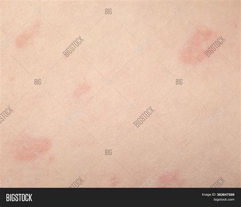 Skin Disease Urticaria Image And Photo Free Trial Bigstock