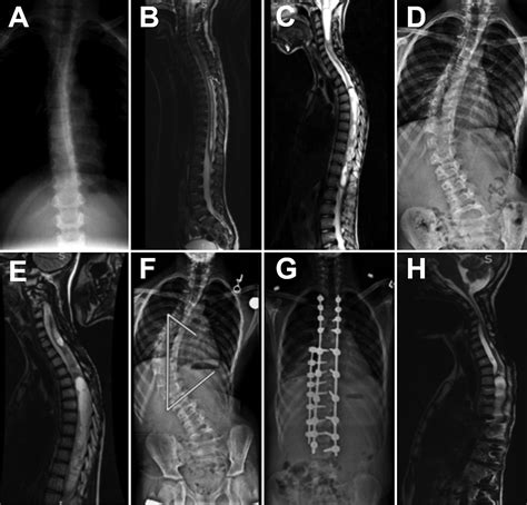 Instrumented Fusion For Spinal Deformity After Laminectomy Or