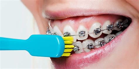 But your teeth might be sore for the first few days and brushing with a soft toothbrush is recommended. How To Brush Your Teeth With Braces | Weber Orthodontics