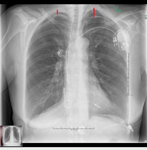 Chest Radiograph Showing Left Apical Pneumothorax Green Arrows Images