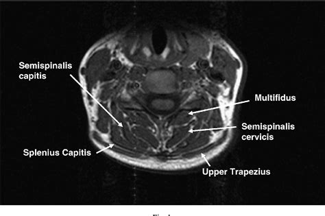 Figure 1 From Mri Study Of The Cross Sectional Area For The Cervical