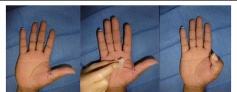 Transverse Anatomic Landmarks For The A1 Pulley Of The Thumb Semantic