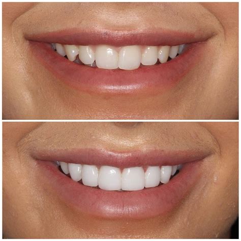 Dental Work Before After Pictures Smiling Dental