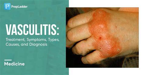 Vasculitis Treatment Symptoms Types Causes And Diagnosis