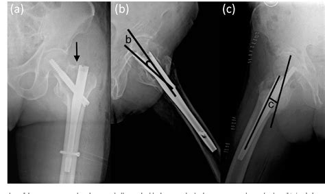 Figure 1 From Risk Factors For Cut‐out Failure Of Gamma3 Nails In