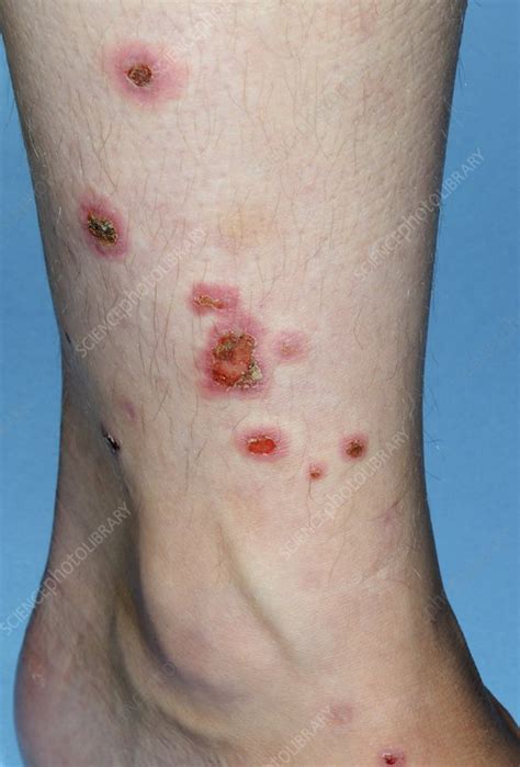 Erythema Multiforme Rash On Leg Stock Image C0115511 Science
