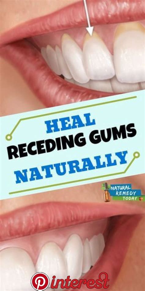 10 Easy Ways To Heal Receding Gums Naturally Teeth Health Receding