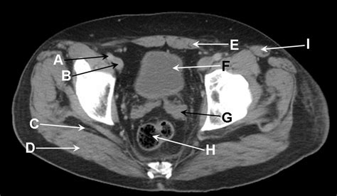 Axial Computed Tomography Of A Male Pelvis In The Portal Venous Phase Post Contrast The Bmj