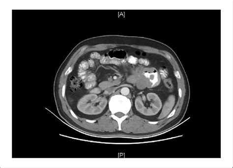 Abdominal Computed Tomography Ct Scan Showed A Mass Originated From