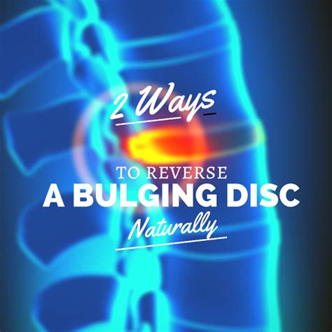 The Top 2 Natural Ways To Reverse A Bulging Disc In Lower Back
