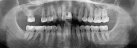 Mercury Fillings, Root Canals, Cavitations - What You Need ...