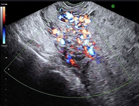 High Definition Flow Doppler Transvaginal Sagittal View Of The Cervix