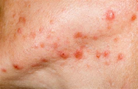 Nodulocystic Acne On Human Skin Stock Photo Image Of Dermatological