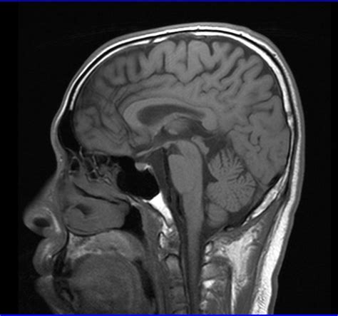 Brain Plain Scan Mri With Dwi Radtechonduty