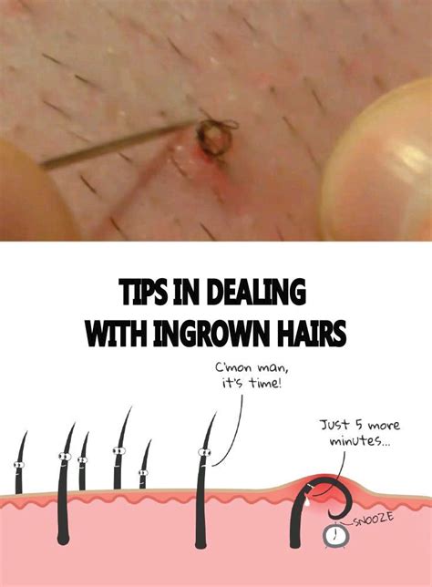 these skin care tips will make your skin happy with images ingrown hair remedies hair