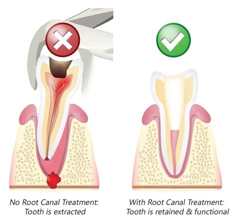 Check spelling or type a new query. What is a Root Canal Treatment? | Twinkle Family Dentalcare