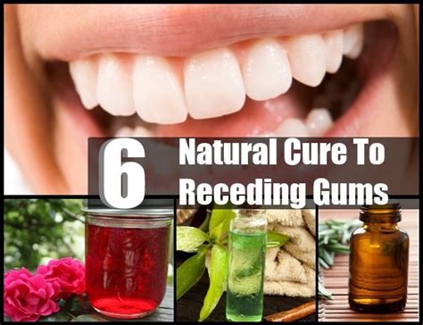 Natural Home Remedies For Receding Gums Healthy Tips