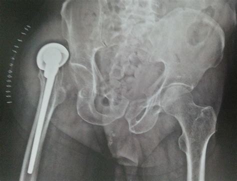 Neck Of Femur Fracture Surgery Wikidoc