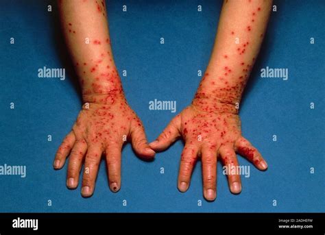 Eczema Herpeticum Affecting The Wrist And Hands Eczema Herpeticum