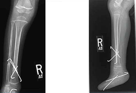 Supramalleolar Derotational Osteotomy In A 3 Year Old Male Fixed With