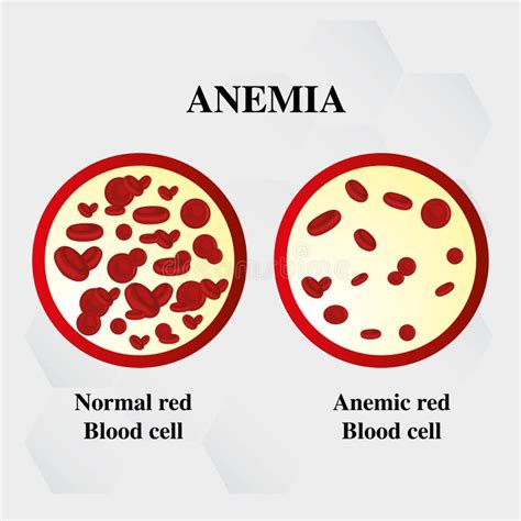 Anemia Symptoms In The Form Of A Drop Of Blood Fatigue Headache