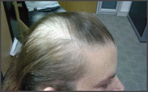 Psoriasis And Hair Loss Pictures Psoriasis Expert