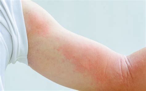 Stress Rash Itchy Skin And Bumps On Baby Hives Symptoms And Causes