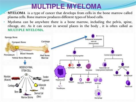 Multiple Myeloma Multiple Myeloma Prognosis 2019 Canceroz