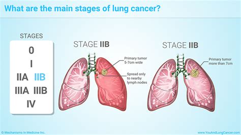 Lung cancer is one of the most deadly cancers, so your care for clients with lung cancer is vital. Slide Show - Staging of Lung Cancer