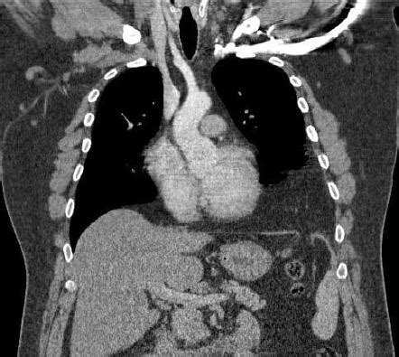 Diaphragmatic Rupture Radiology Reference Article Radiopaedia Org