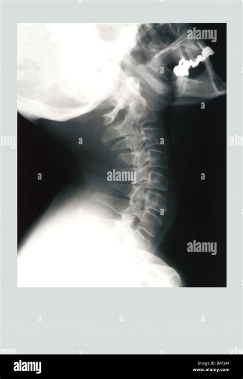 Skull And Neck Stock Photo Alamy