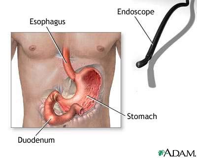 Gastric Endoscopy Medlineplus Medical Encyclopedia Image