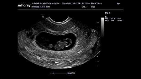Ultrasound Scan Pregnancy 8 Weeks File Ob1 Youtube
