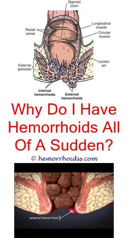 What Is Fissure What Is Hemorrhoid