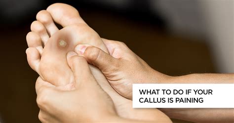 Corns And Callus Causes Symptoms Treatment And Difference