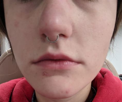 Acne Face Clearing Up Except Skin Tips On Dealing With Healing Big