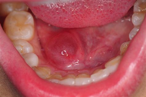 Swelling Related to Ranula Under The Tongue | Swelling Related to Ranula Under The Tongue ...