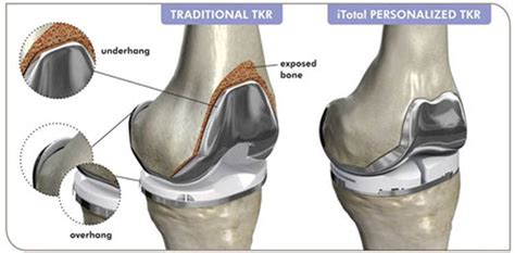 Conformis Ipo For 3d Printed Knees 3d Printing Industry