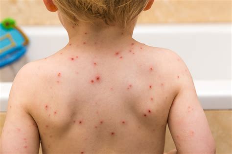 Does My Baby Have A Viral Rash Ready Set Food