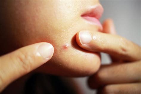 What Does Chin Acne Mean—and How To Get Rid Of It Readers Digest