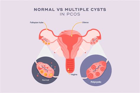 how pcos can affect a woman s quality of life and self esteem onecare wellness