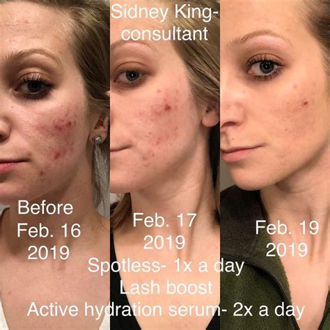 Rodan And Fields Before And After Spotless All You Need Infos