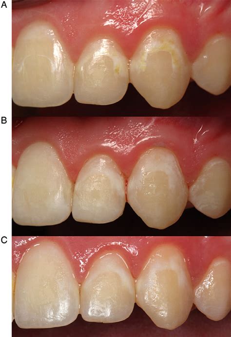 Figure 3 From A Contemporary Review Of White Spot Lesions In