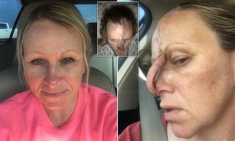 Sun Worshipper Left With A Gaping Hole In Her Nose After Developing