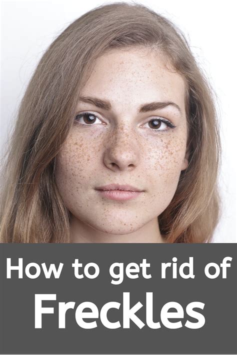 How To Get Rid Of Freckles How To Remove Freckles What Are Freckles What Causes Freckles