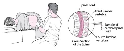 Table Lumbar Puncture Merck Manuals Professional Edition