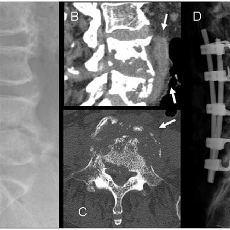 Transpedicle Ct Guided Disk Biopsy At The Thoracic Spine Ad Mri